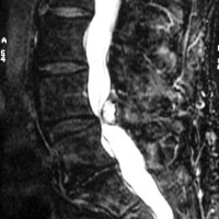 MRI Of Degenerative Disc Disease