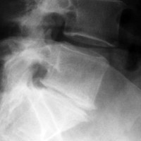 Xray Of Degenerative Disc Disease