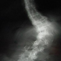 Xray Of Degenerative Scoliosis